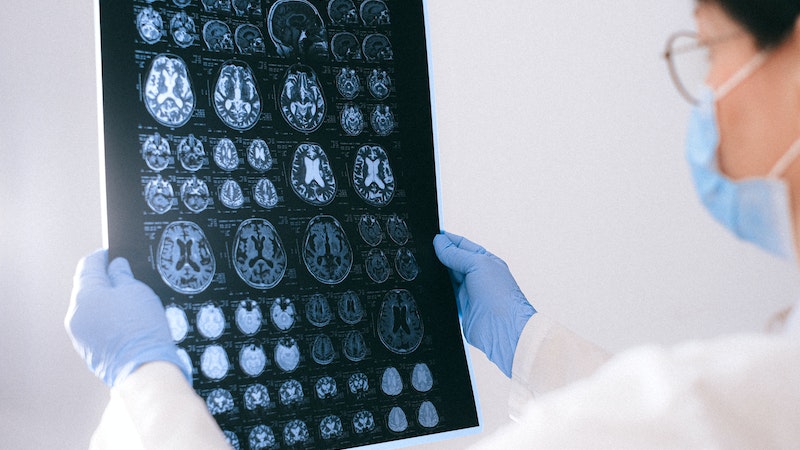 Umut veren Alzheimer ilacı! İlk kez tedavi etti Deneysel ilaç lecanemab, üçüncü aşama klinik denemelerinde Alzheimer hastalığının tedavisinde